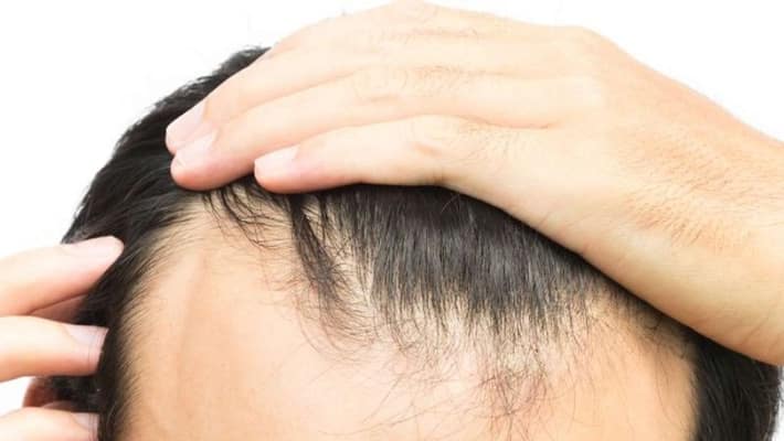youth commits suicide over losing hair in hyderabad youth commits suicide over losing hair in hyderabad