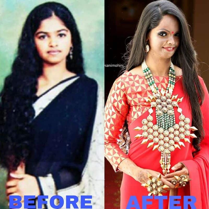 Laxmi was just 15 years old when a 32-year-old spurned suitor  threw acid on her for rejecting  his advances.  After undergoing multiple corrective procedures, Laxmi maintains, "He changed my face, not my dreams.”