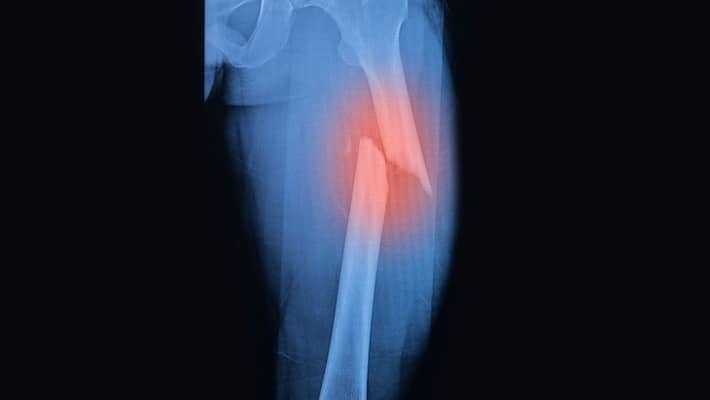 small bone injury stops density of other bones small bone injury stops density of other bones