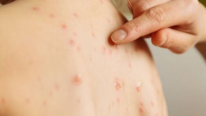 measles symptoms and prevention tips measles symptoms and prevention tips
