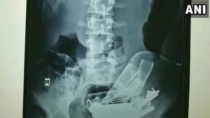 80 objects removed from man stomach in rajasthan 80 objects removed from man stomach in rajasthan