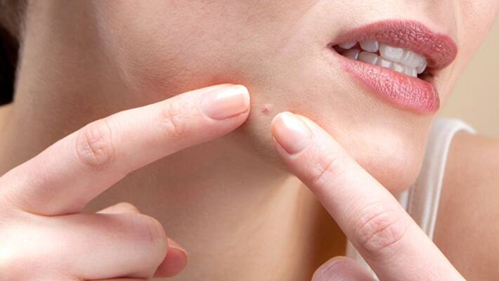 try to control pimples try to control pimples