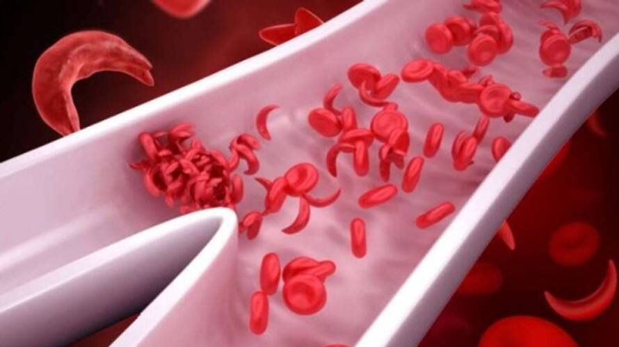 what is sickle cell anemia symptoms and causes res what is sickle cell anemia symptoms and causes res