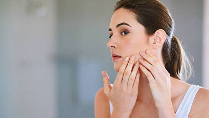 Five daily habits that are probably giving you acne Five daily habits that are probably giving you acne