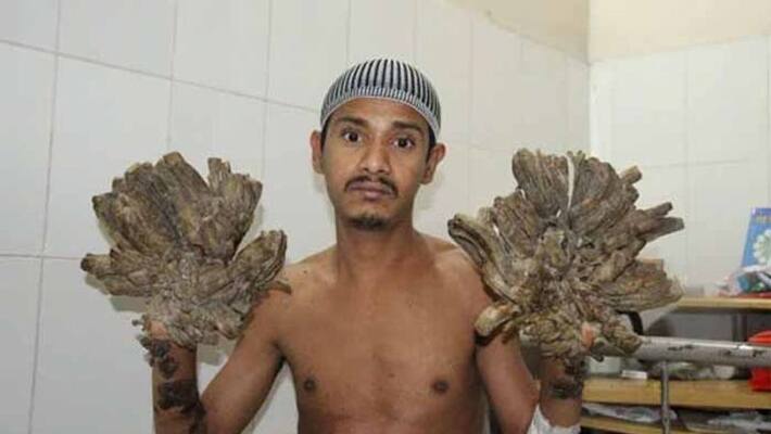 bangladesh man suffered from tree man syndrome bangladesh man suffered from tree man syndrome