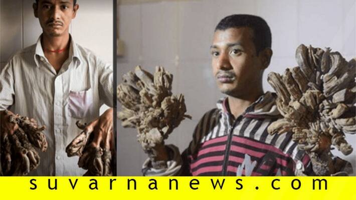 Bangladesh Tree Man begs for hands to be CUT OFF after undergoing 25 surgeries Bangladesh Tree Man begs for hands to be CUT OFF after undergoing 25 surgeries