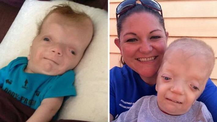 baby born with defects blind, deaf, hole in his heart rare syndrome baby born with defects blind, deaf, hole in his heart rare syndrome