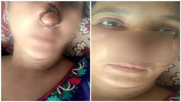 husband bites wifes nose in gujrat husband bites wifes nose in gujrat