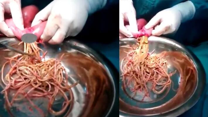 Video of surgically extracted intestinal worms falsely claimed as undigested noodles Video of surgically extracted intestinal worms falsely claimed as undigested noodles