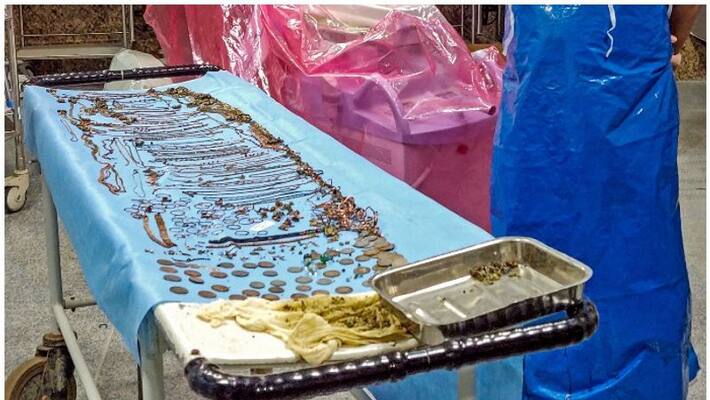 Gold, copper and brass in young woman's stomach .. Doctors shock Gold, copper and brass in young woman's stomach .. Doctors shock