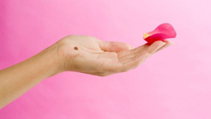 Know about moles in palm and its impact Know about moles in palm and its impact
