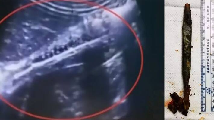 Doctors remove toothbrush from man stomach after 20 years Doctors remove toothbrush from man stomach after 20 years