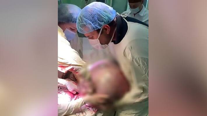 Doctors removed 25 kg tumour from old woman ovary Doctors removed 25 kg tumour from old woman ovary