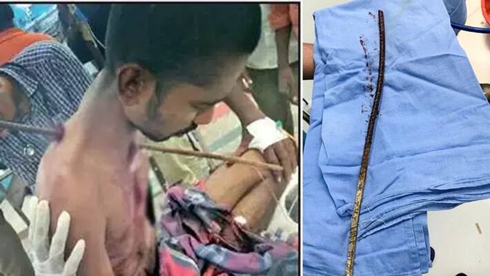 Iron rod pierced chest man survives in madurai Iron rod pierced chest man survives in madurai