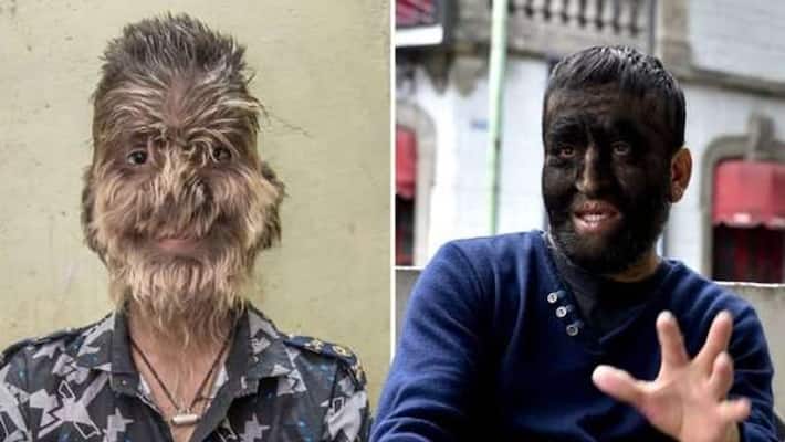 warewolf syndrome in spain affects 16 children warewolf syndrome in spain affects 16 children