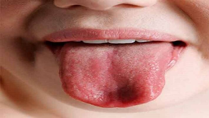 If you have blisters in your mouth then do these 5 home remedies If you have blisters in your mouth then do these 5 home remedies