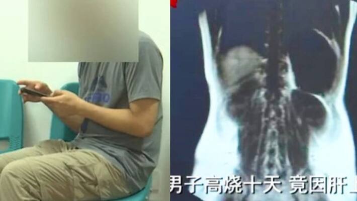 Man infected with dangerous Parasitic worms after eating raw seafood Man infected with dangerous Parasitic worms after eating raw seafood