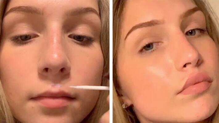 Tiktok users gluing lips with fevicol under weird challenge Tiktok users gluing lips with fevicol under weird challenge