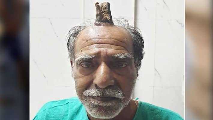 Rare case of sebaceous horn exposed in Madhya Pradesh, horn on head of man, A cutaneous horn is a type of growth that appears on the skin Rare case of sebaceous horn exposed in Madhya Pradesh, horn on head of man, A cutaneous horn is a type of growth that appears on the skin