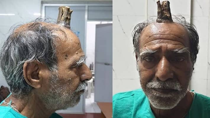 The horn on the head of this person, the doctor was also shocked The horn on the head of this person, the doctor was also shocked