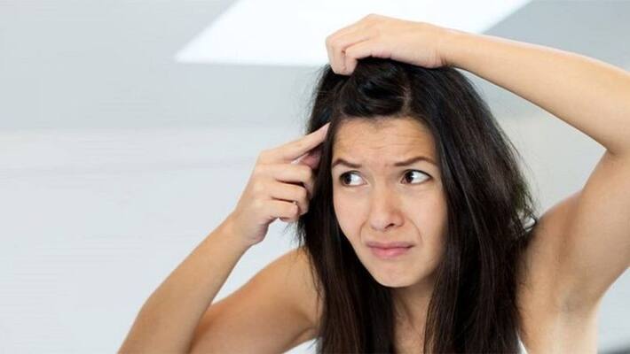 natural home remedies for Rid of Dandruff natural home remedies for Rid of Dandruff