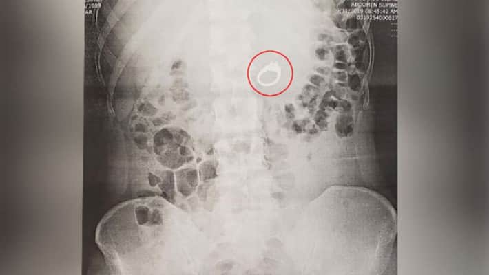 girl swallowed her engagement ring while dreaming at night girl swallowed her engagement ring while dreaming at night