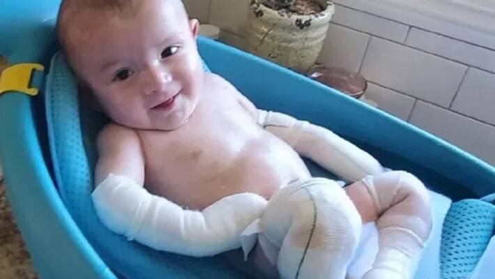 Parents avoid touching kid suffering from rare skin disease Parents avoid touching kid suffering from rare skin disease