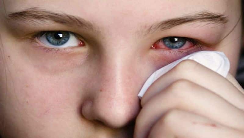 This season viral infections of the eye Conjunctivitis and its early symptoms BDD