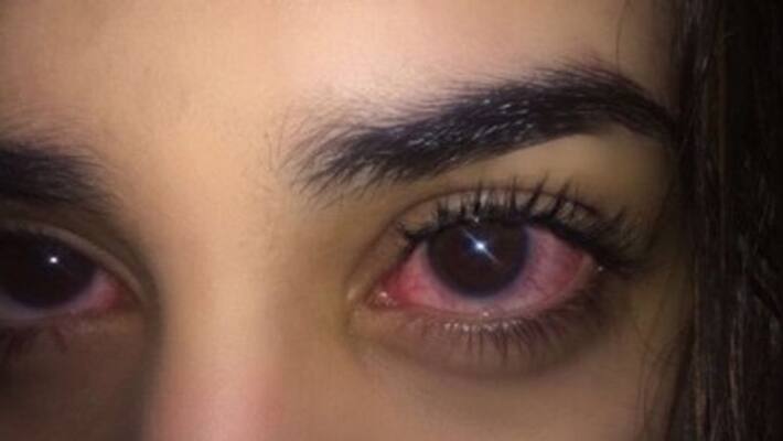 16 yo girl turned color blind after using smartphone for 10 hours daily 16 yo girl turned color blind after using smartphone for 10 hours daily