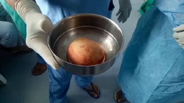 biggest kidney stone ever removed through successful surgery biggest kidney stone ever removed through successful surgery