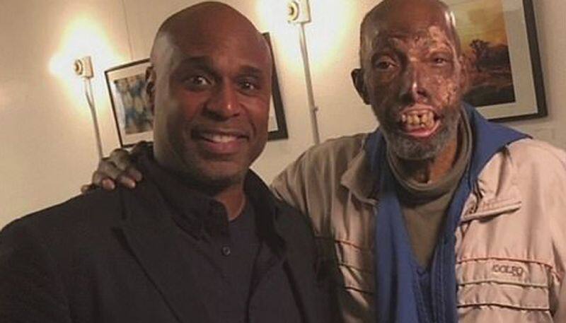 Robert Chelsea  first African American receive  face transplant