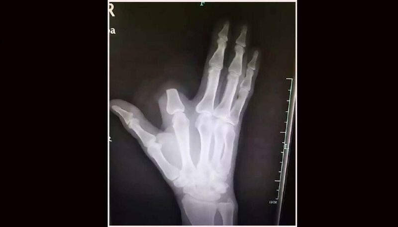 Man cuts finger off after snake bite