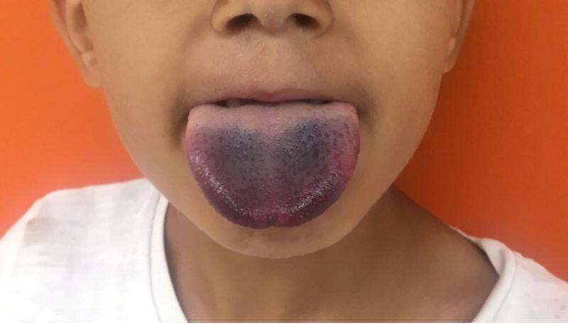 These color of the tongue will tell the health conditions BDD