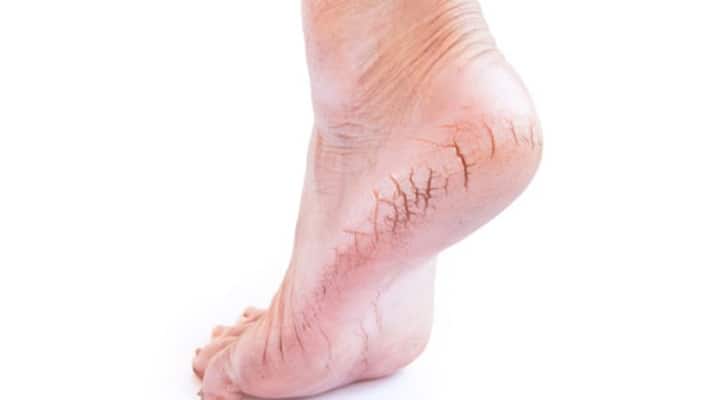 Here how you can say goodbye to cracked heels with these home remedies-dnm Here how you can say goodbye to cracked heels with these home remedies-dnm