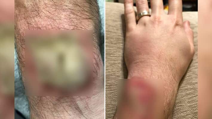 Man got third degree burn from fitness watch after he slept wearing them Man got third degree burn from fitness watch after he slept wearing them