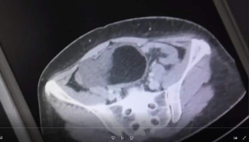 doctors found a big cyst on woman s ovary