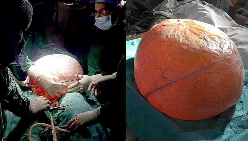 woman s ovarian cyst was stopped her ability to breathe