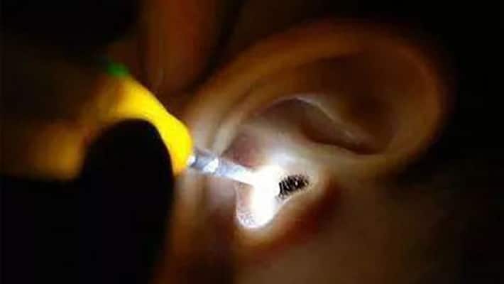 Doctor pulls out live cockroach from womans ear Doctor pulls out live cockroach from womans ear
