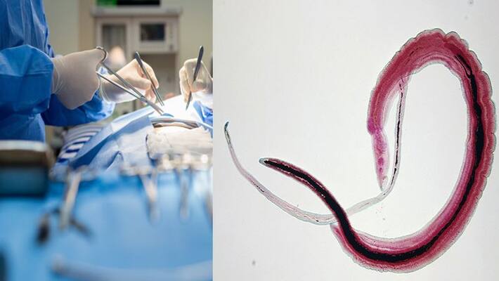 Chinese man infected with parasitic flatworm after eating undercooked fish, loses half his liver Chinese man infected with parasitic flatworm after eating undercooked fish, loses half his liver