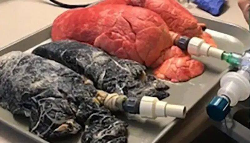 images of lungs of a chain smoker who puffed a pack a day for 30 years