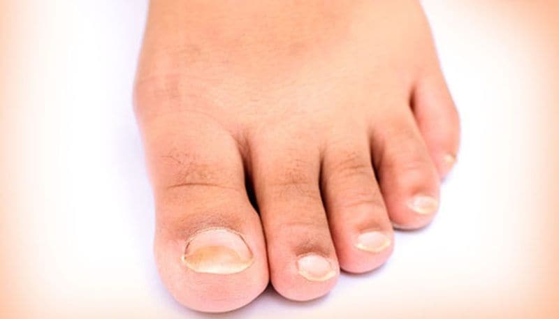 What nail colors says about your health condition