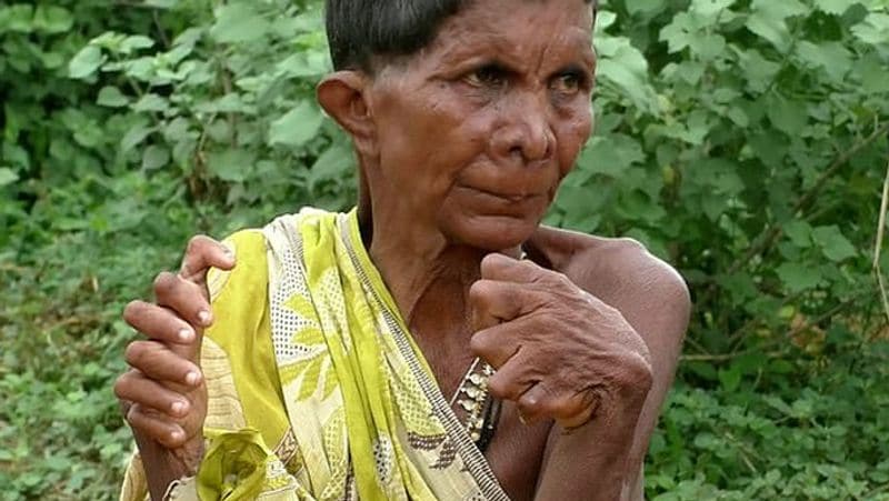 Indian woman called witch for being born with 19 toes and 12 fingers