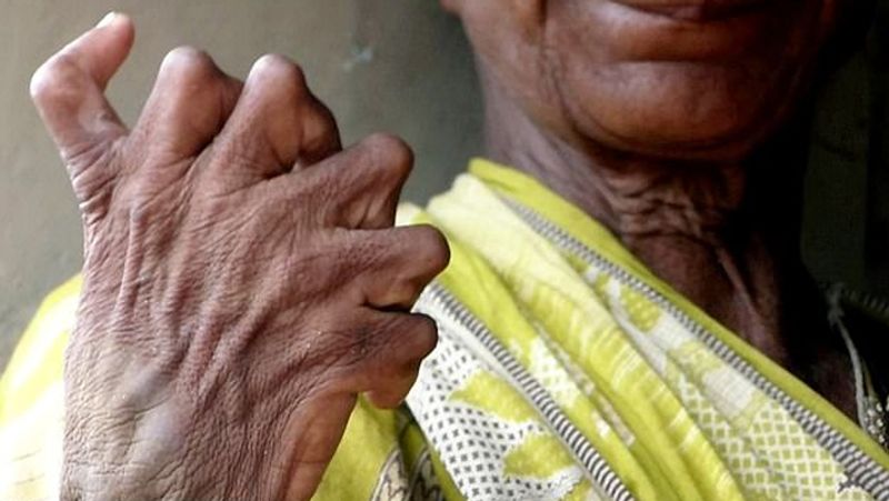 Indian woman called witch for being born with 19 toes and 12 fingers
