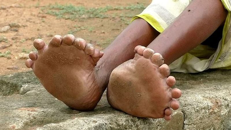 Indian woman called witch for being born with 19 toes and 12 fingers