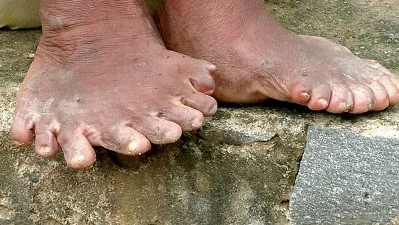 Indian woman called witch for being born with 19 toes and 12 fingers