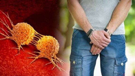 Tips to prevent prostate cancer rsl Tips to prevent prostate cancer rsl