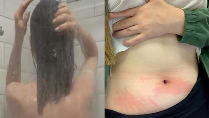 21 year old girl allergic to water get rashes even if she cries 21 year old girl allergic to water get rashes even if she cries