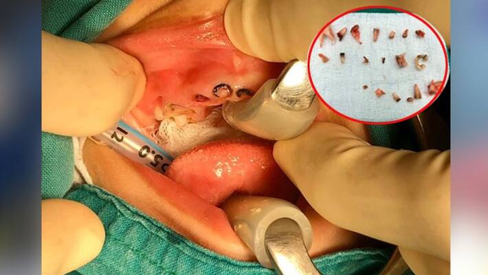 Doctors removed all 20 rotten teeth from 4 year old boy mouth Doctors removed all 20 rotten teeth from 4 year old boy mouth