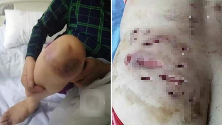 Doctor was treating with 1 injection without cleaning, skin of 115 people rotten Doctor was treating with 1 injection without cleaning, skin of 115 people rotten