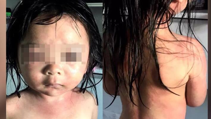 5 year old girl suffers horrific burns reacting chlorine used in clean swimming pool 5 year old girl suffers horrific burns reacting chlorine used in clean swimming pool